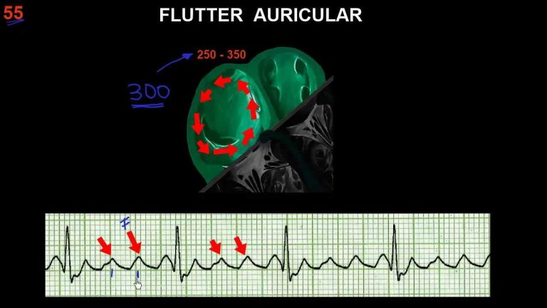 Fibrilación auricular: Todo lo que debes saber sobre el Electrocardiograma